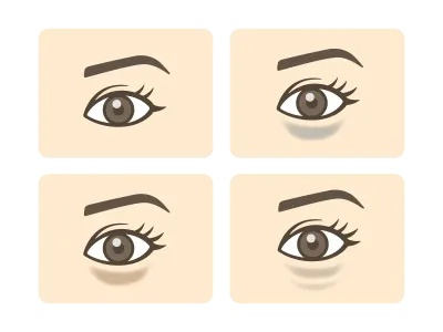 目の下のクマの種類のイラスト