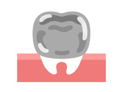 銀歯のイラスト