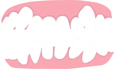 crowding, list of orthodontic dental problem