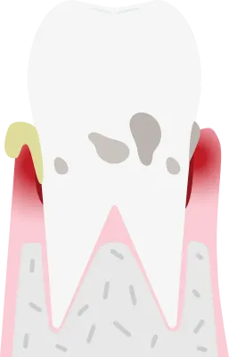 Illustration by stage of periodontal disease moderate periodontitis