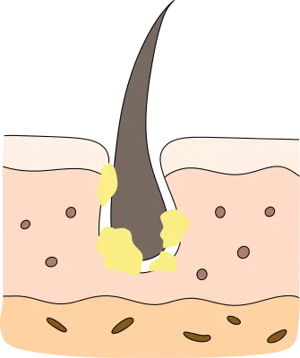 毛穴の皮膚管理のためのスキンケア