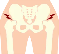 hip pain2