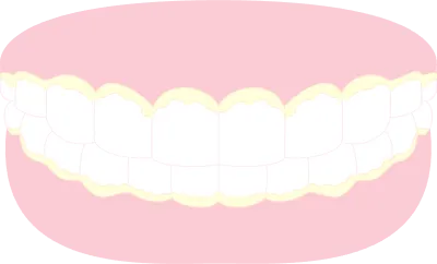 Illustration of plaque sticky teeth and gums