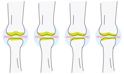 Vector illustrations with osteoarthritis of the knee will wear out the meniscus