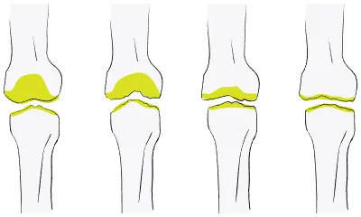 Vector illustration of the flow of osteoarthritis of the knee is worse