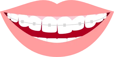 Illustration of esthetic dentistry and orthodontics Distorted tooth arrangement and metal bracket
