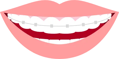 Illustration of esthetic dentistry and orthodontics beautiful teeth arrangement and metal bracket