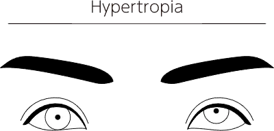 Medical illustrations, diagrammatic line drawings of eye diseases, strabismus and hypertropia