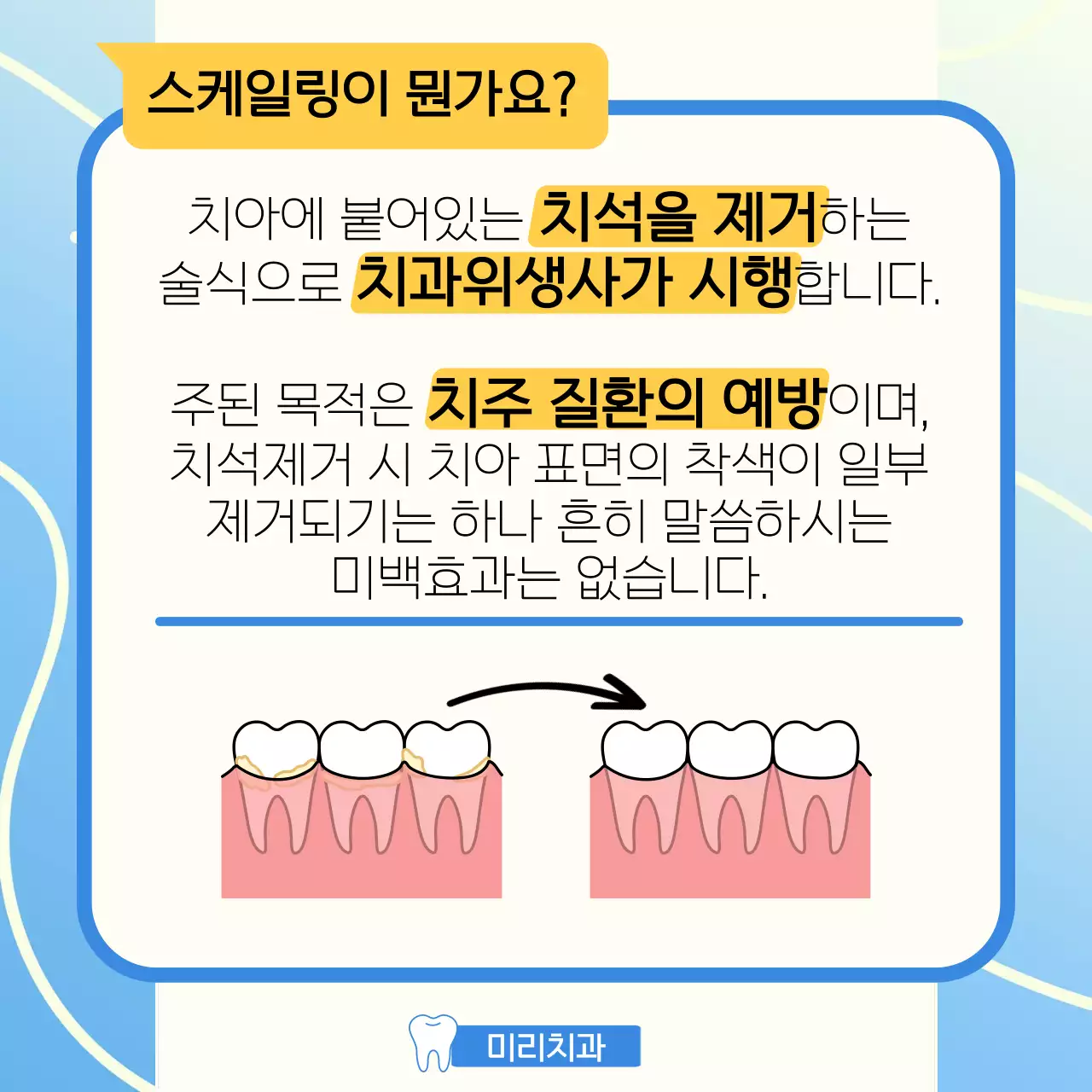 파란색 배경의 치과위생사가 알려주는 스케일링