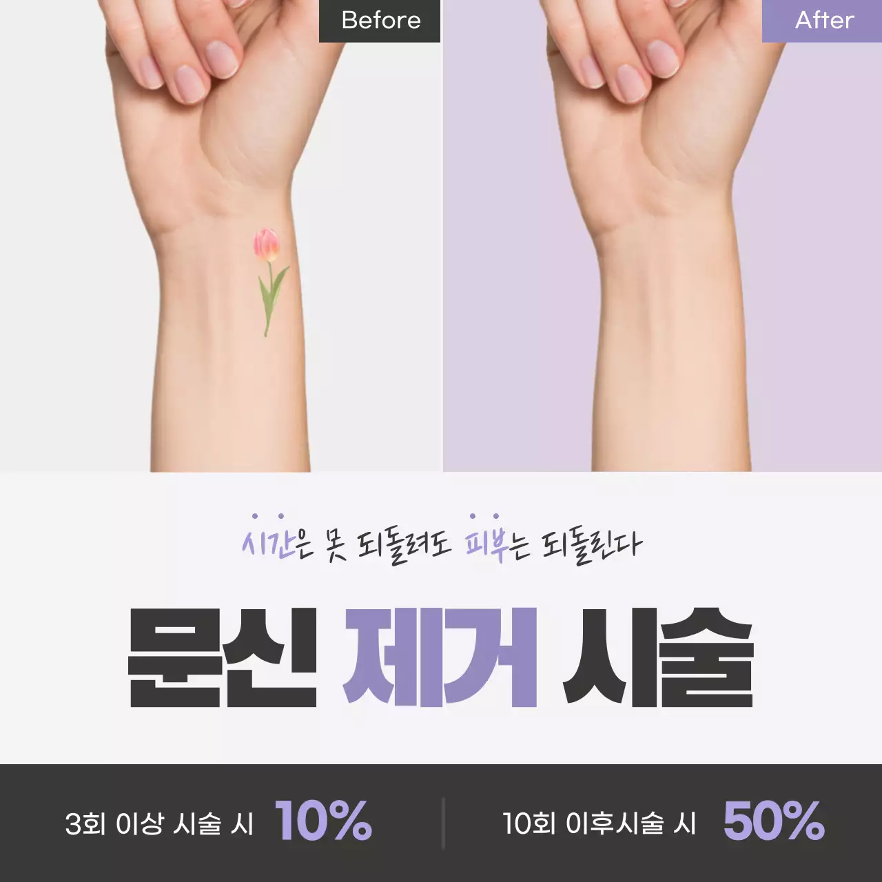 라벤더 포인트의 심플한 문신 제거 시술 홍보