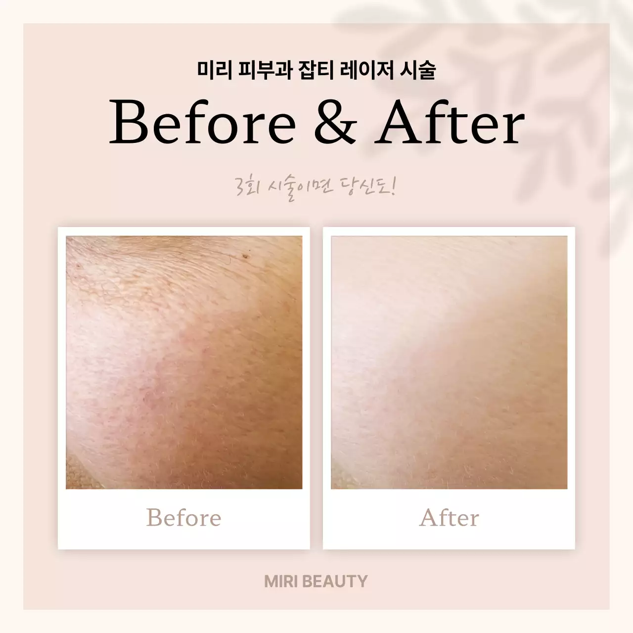 베이지의 미니멀한 시술 전후 홍보