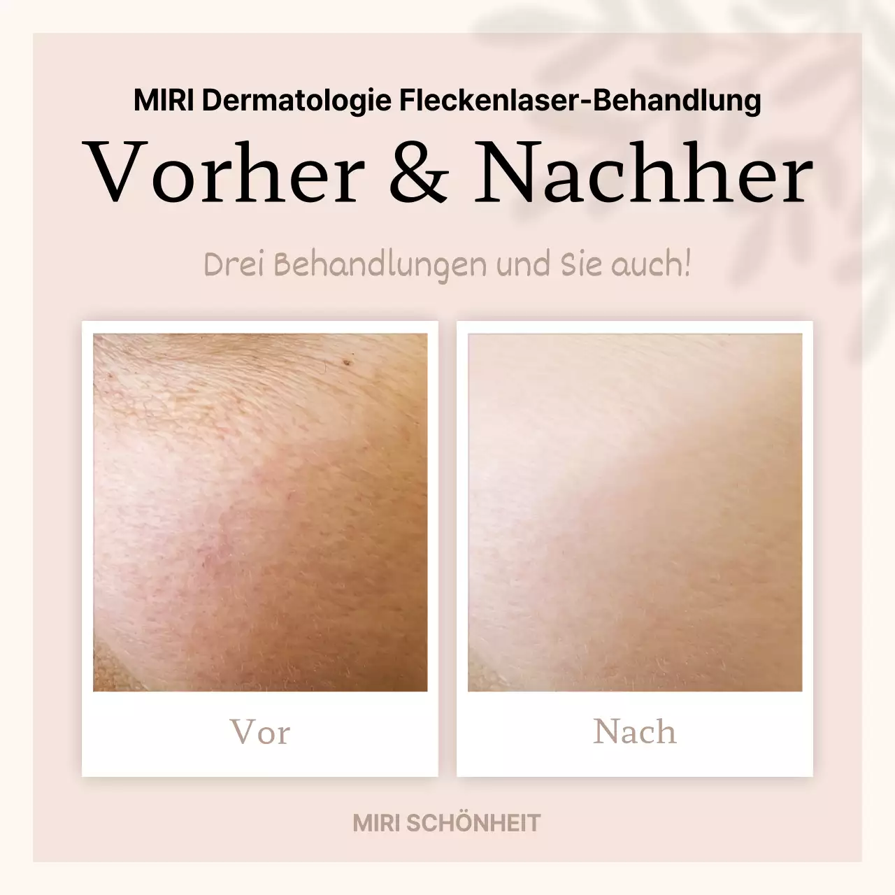 Beige, minimalistische Werbung vor und nach dem Verfahren