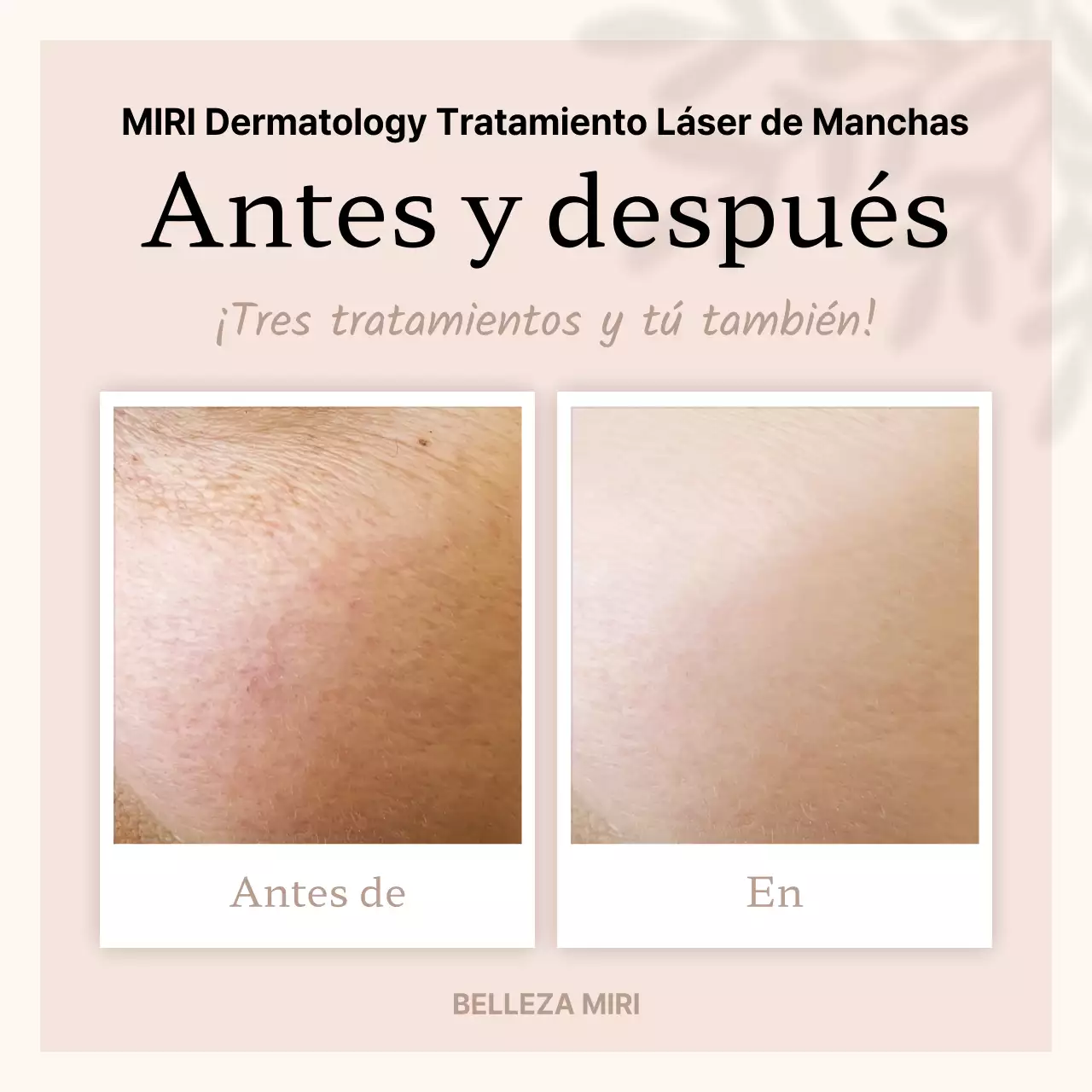 Publicidad beige y minimalista antes y después del procedimiento