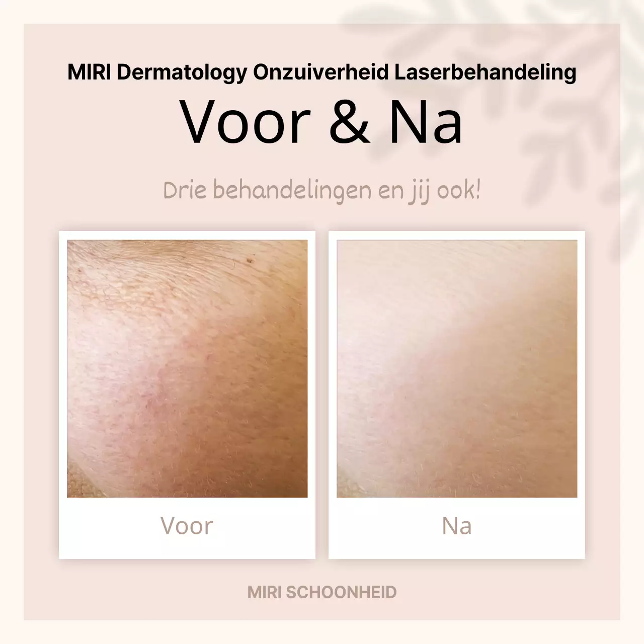 Beige, minimalistische publiciteit voor en na de procedure