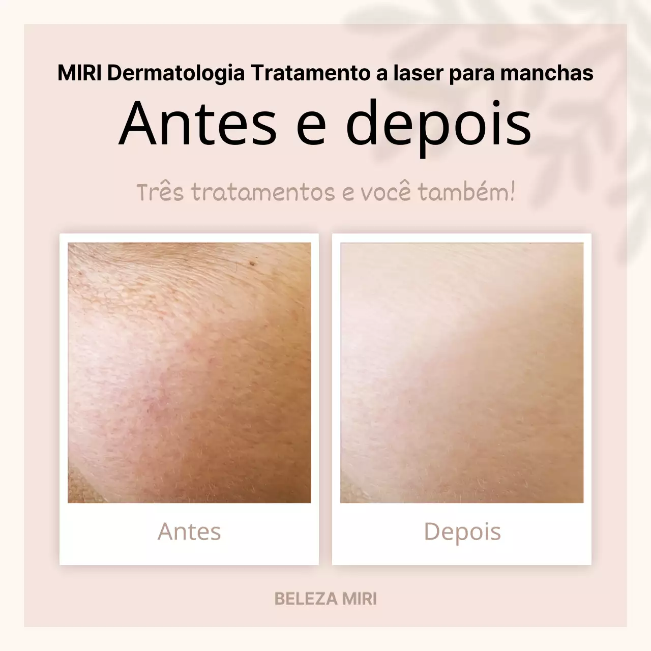 Publicidade pré e pós-procedimento bege e minimalista