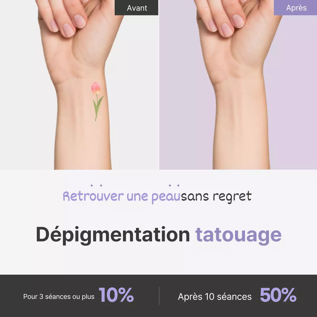 Promouvoir la procédure simple de détatouage de Lavender Point