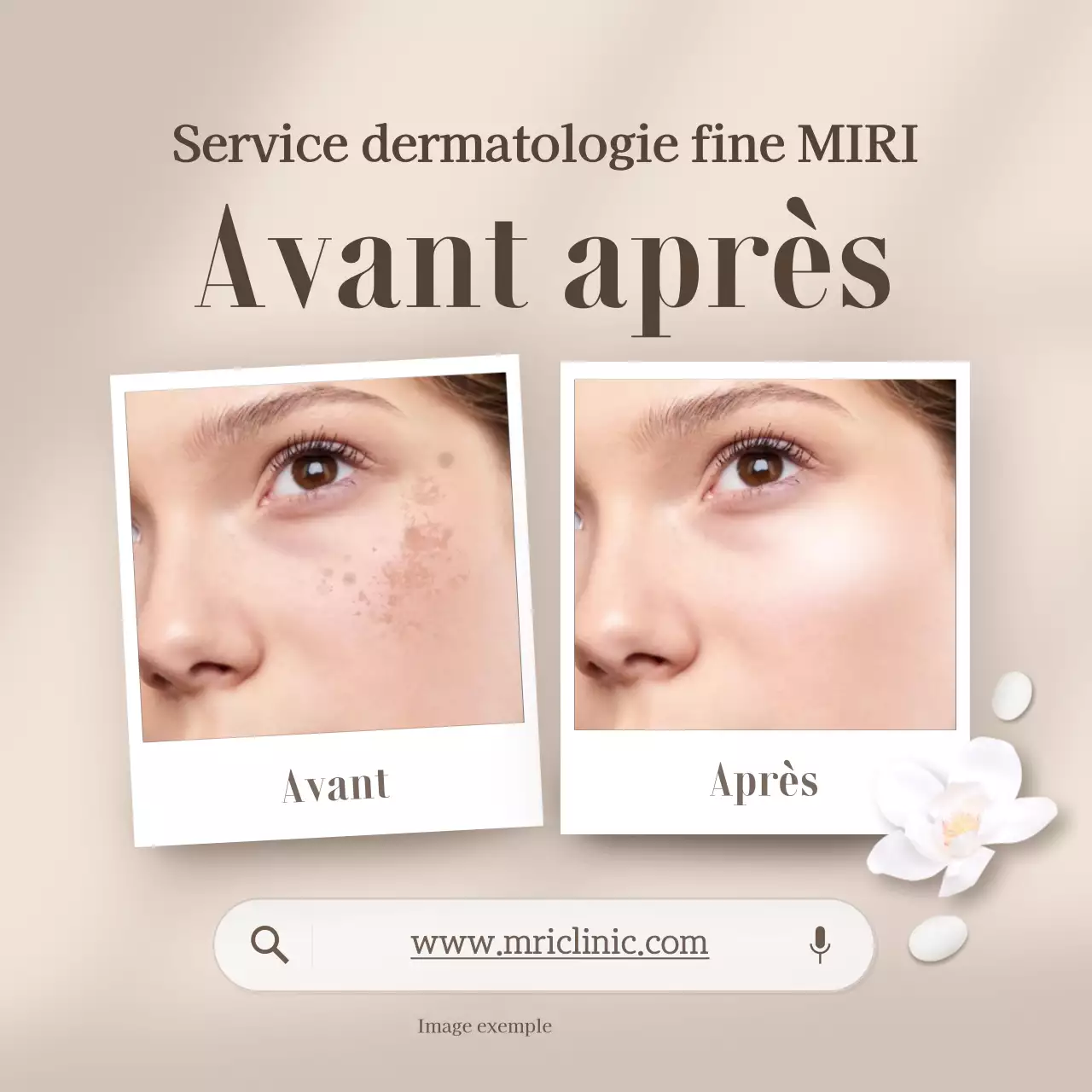 Promouvoir le beige, photos de comparaison avant et après en dermatologie moderne