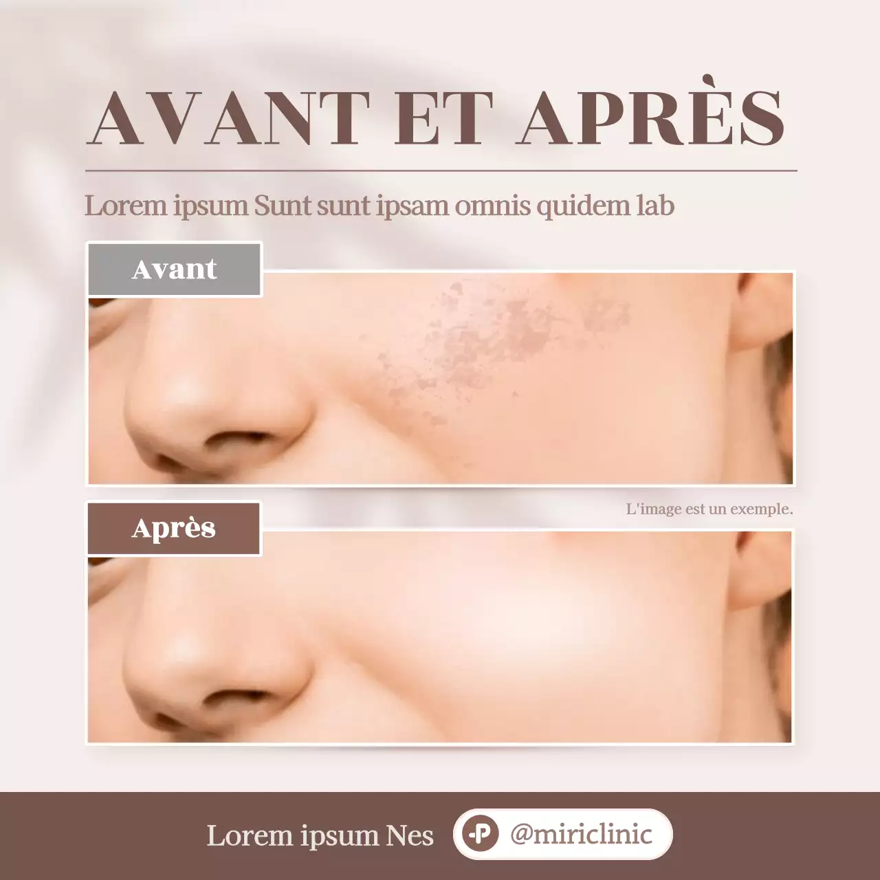 Promouvoir le beige, photos de comparaison avant et après en dermatologie moderne
