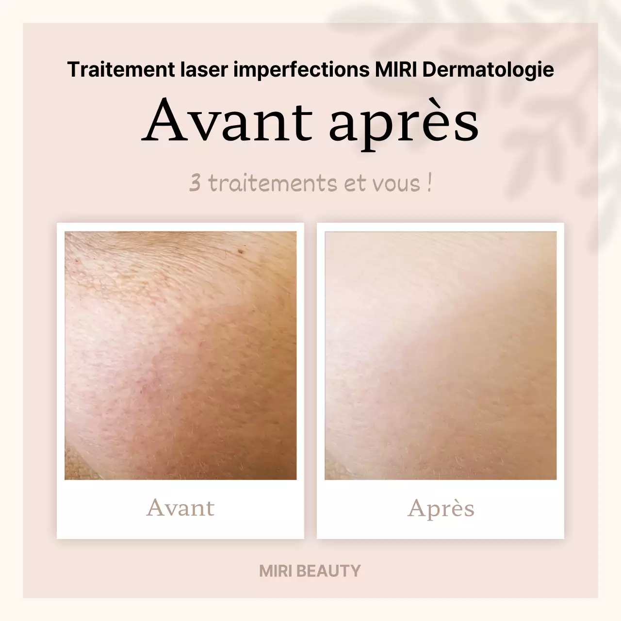 Publicité beige et minimaliste avant et après l'intervention