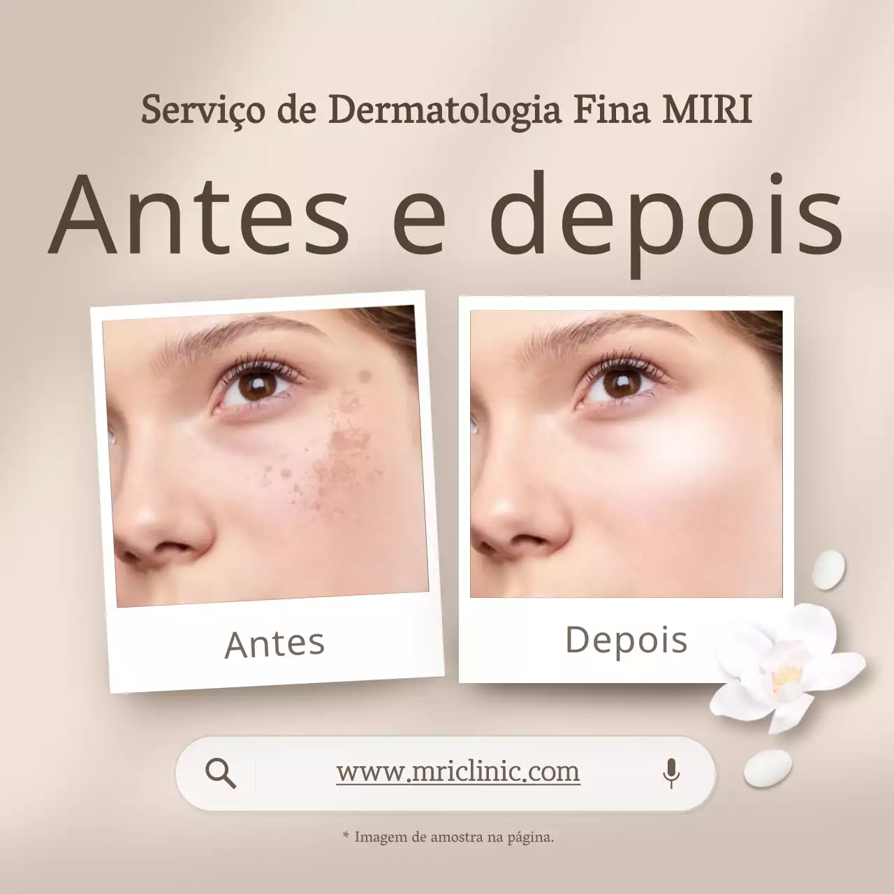 Promote beige, dermatologia moderna fotos de comparação antes e depois