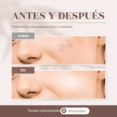 Promover beige, dermatología moderna fotos comparativas antes y después
