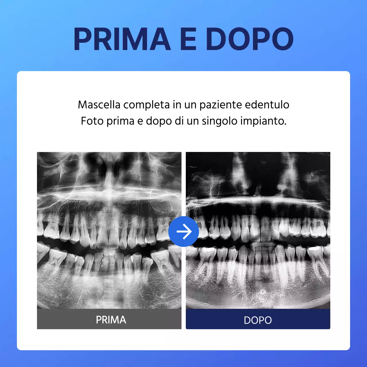 Promozioni di Blue's Simple Implant Dentistry