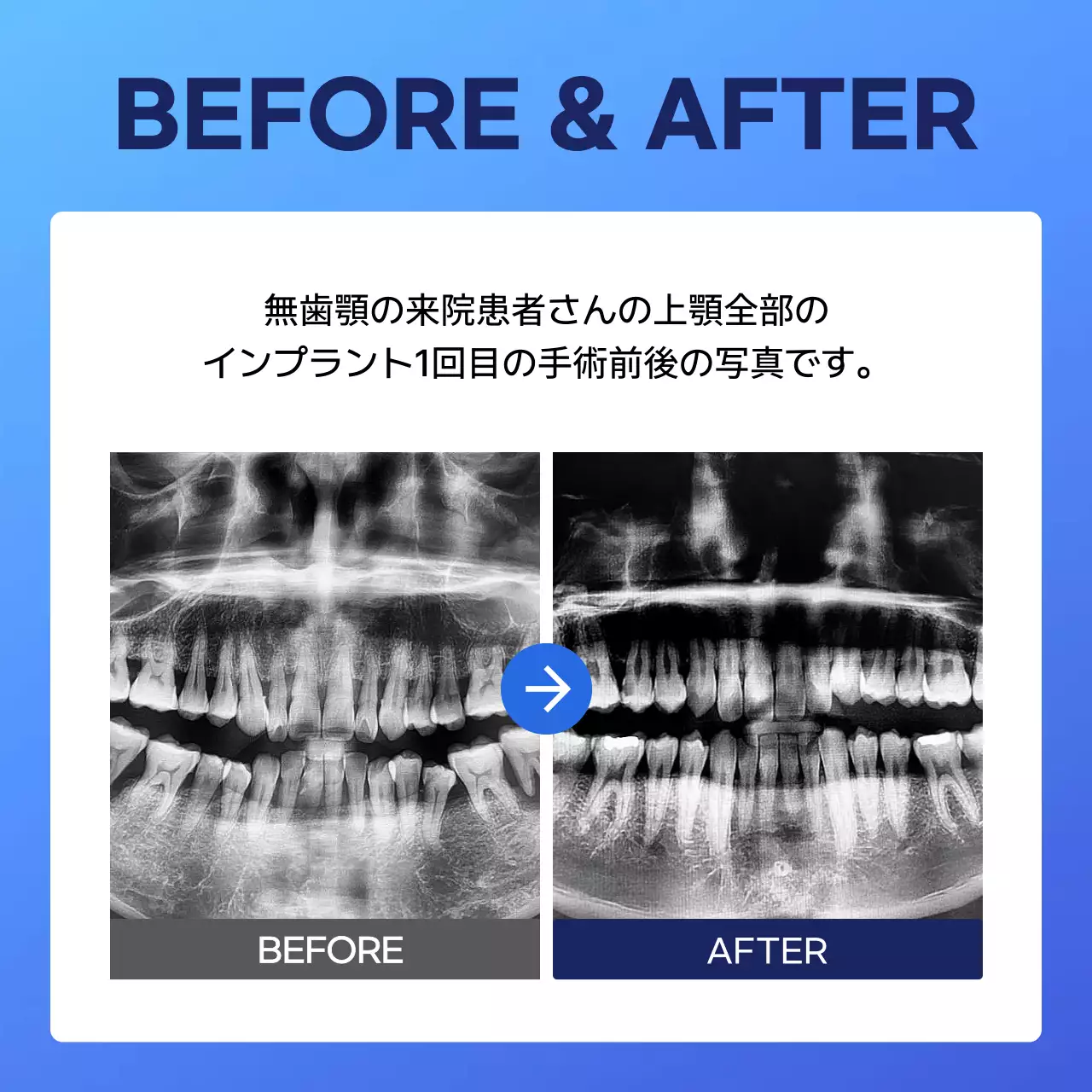 青 シンプル 歯科 ポスター Instagram カルーセル