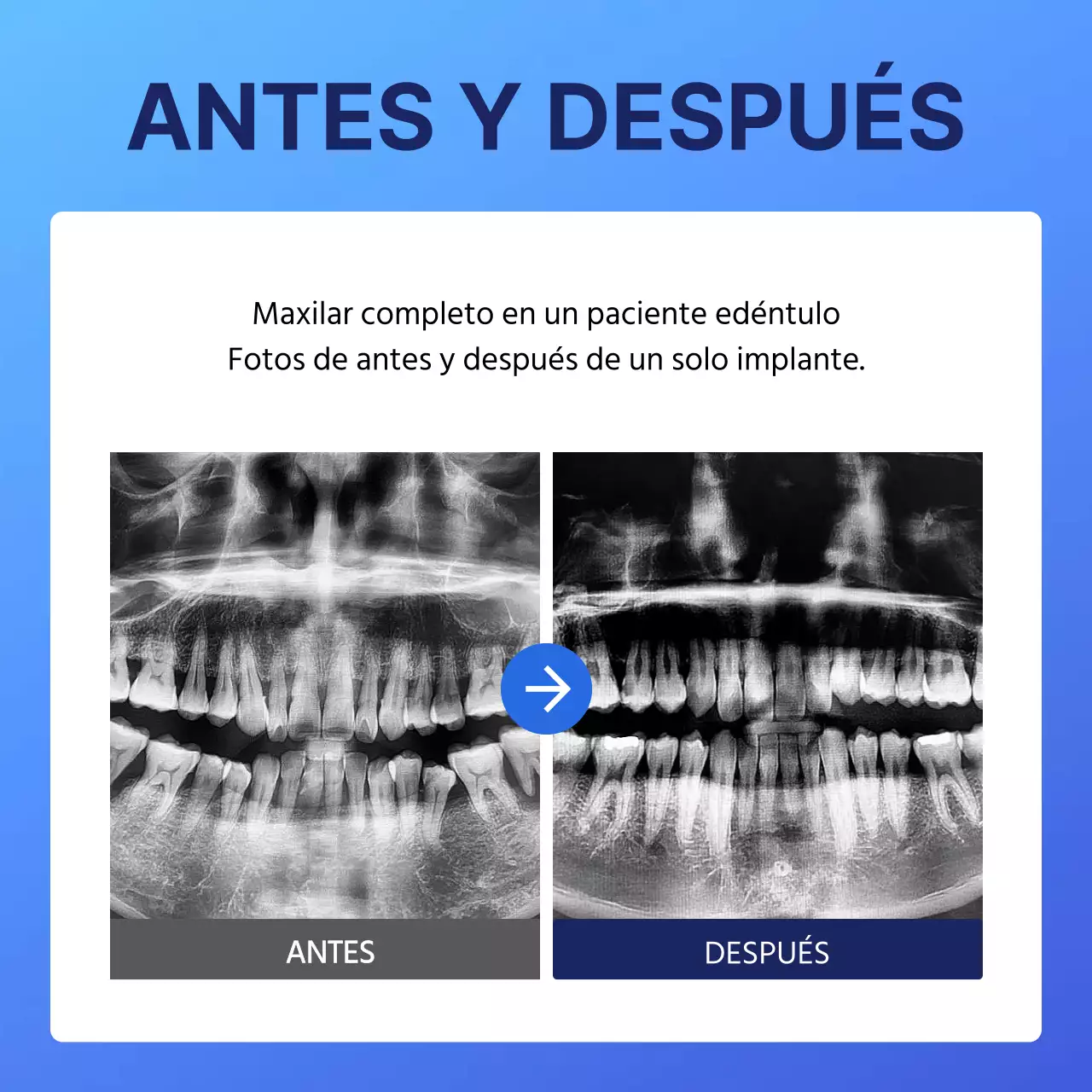 Promociones de Blue's Simple Implant Dentistry