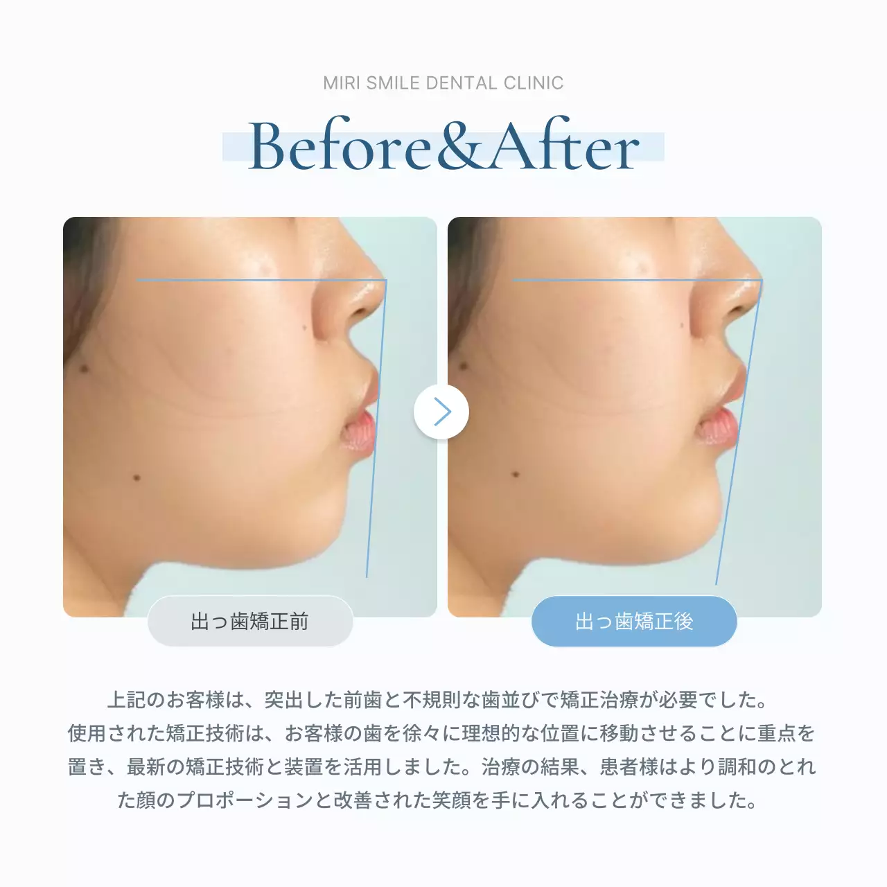 青 シンプル 歯科治療 お知らせ SNS投稿 正方形