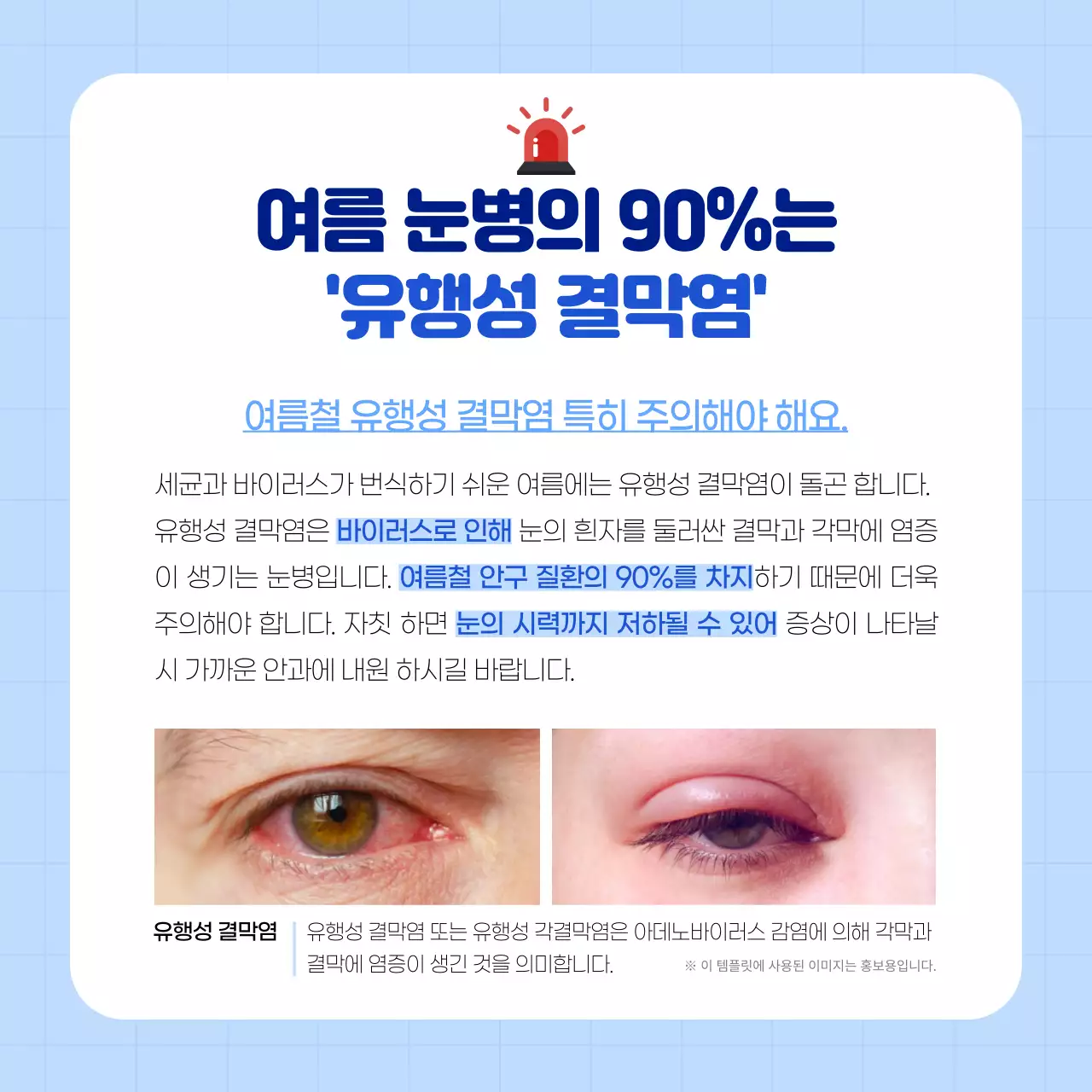 하늘색과 흰색의 깔끔한 결막염 카드뉴스