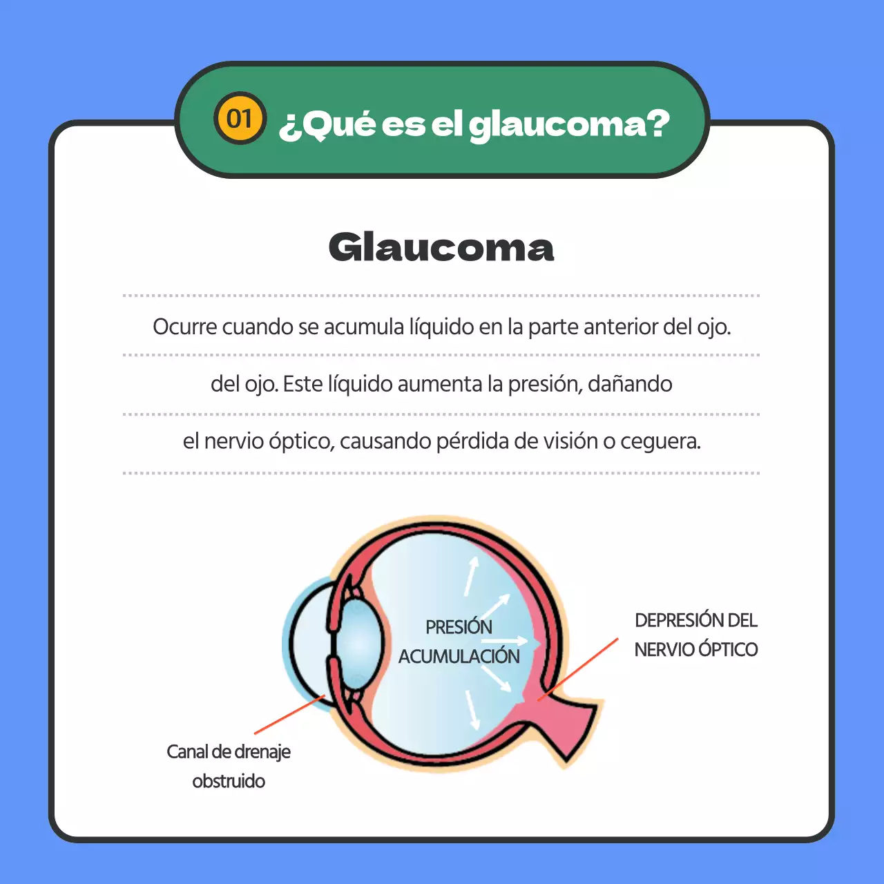 Información sobre el glaucoma resaltada en azul
