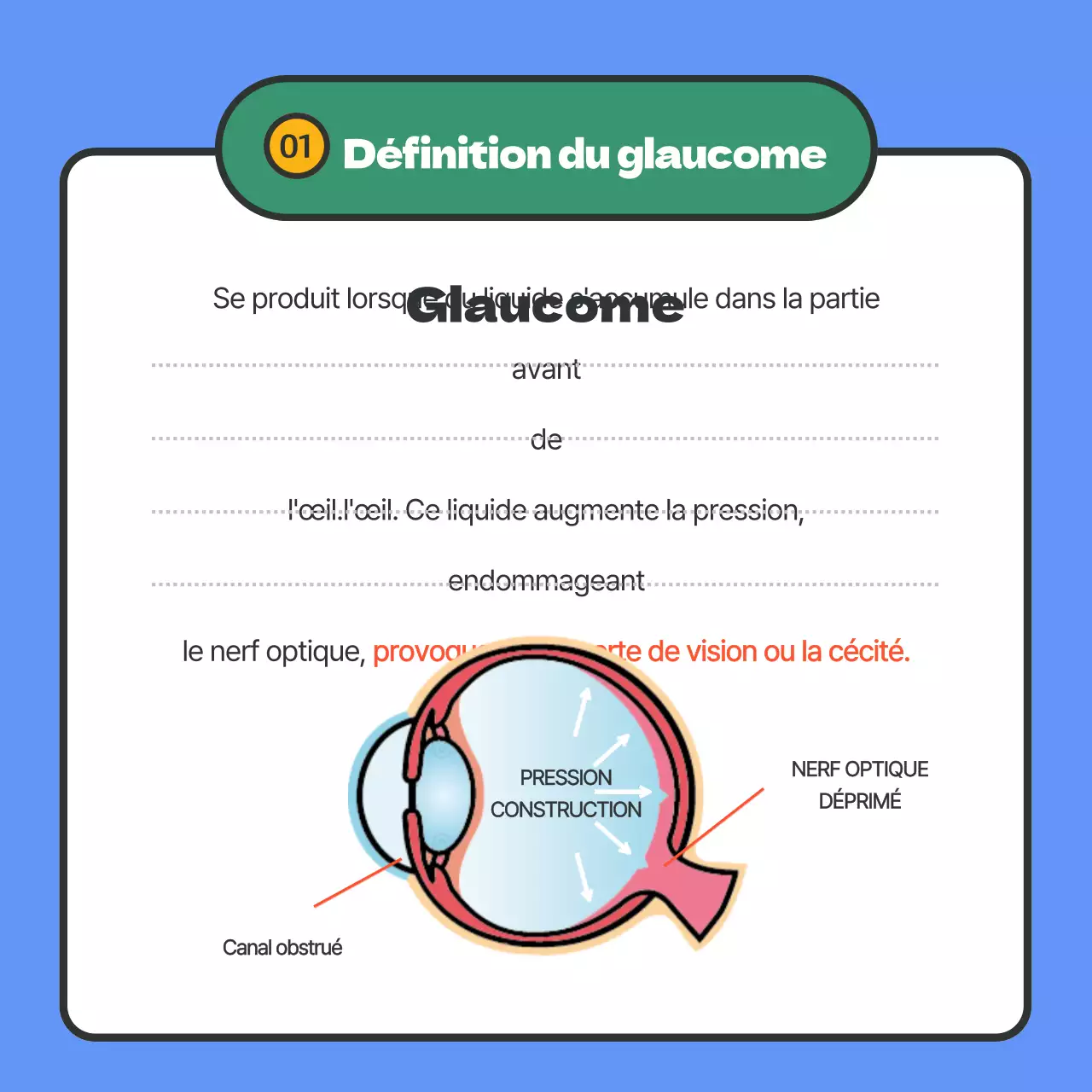 Fournit des informations sur le glaucome en surbrillance bleue.