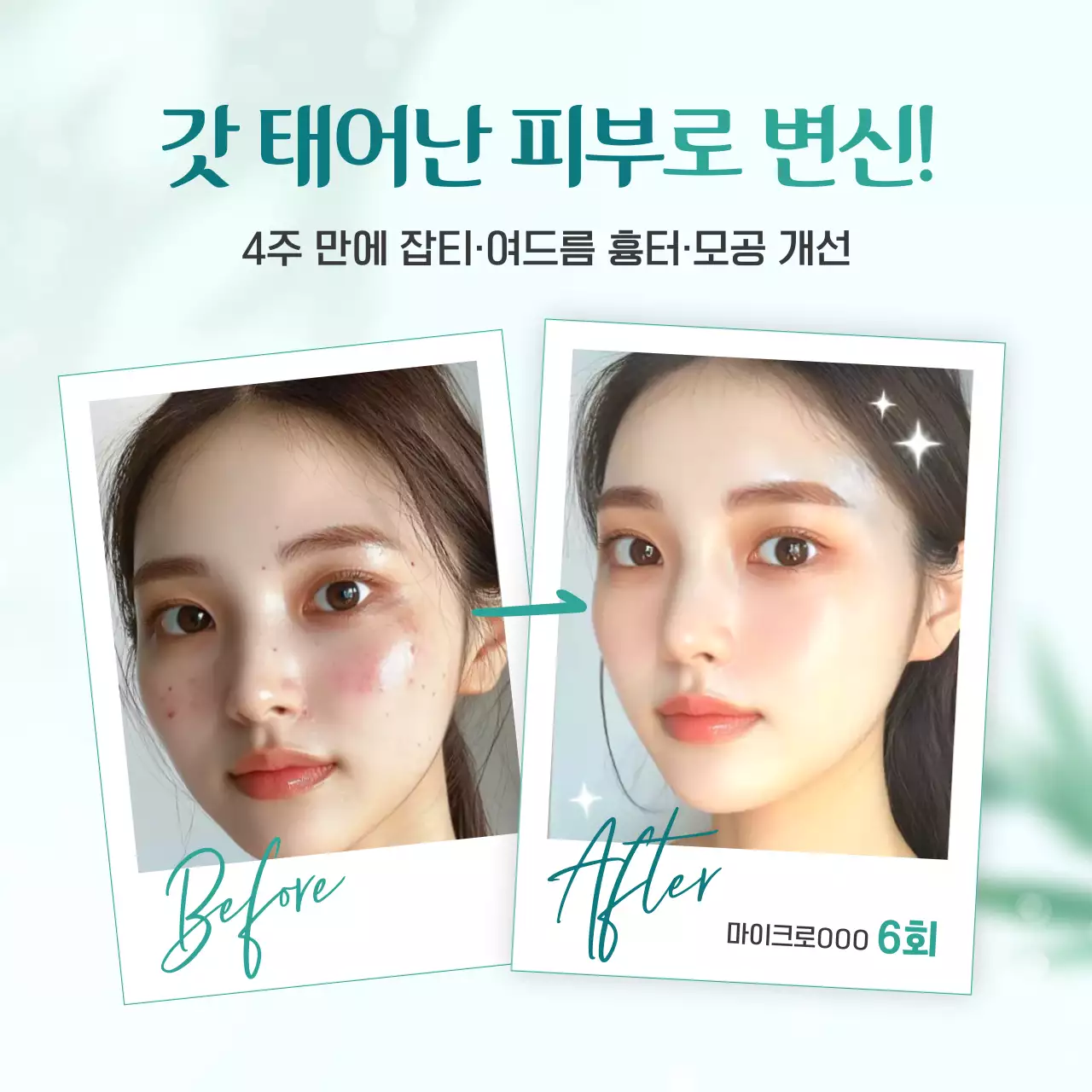 초록색의 깔끔한 여름철 성형외과와 피부과 피부 시술 광고