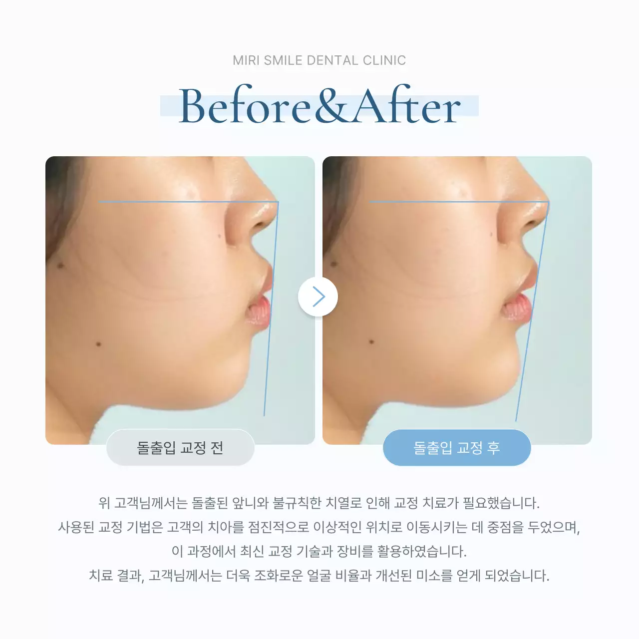 흰색과 하늘색의 심플한 치과를 홍보하기위한 병원 마켓팅 sns 소셜미디어 키트 홍보