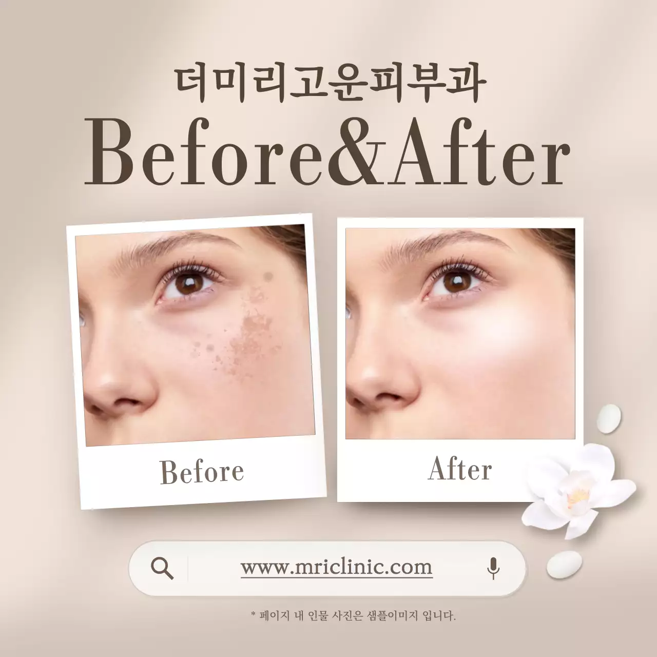 베이지색의 모던한 피부과 비포애프터 비교 사진 홍보
