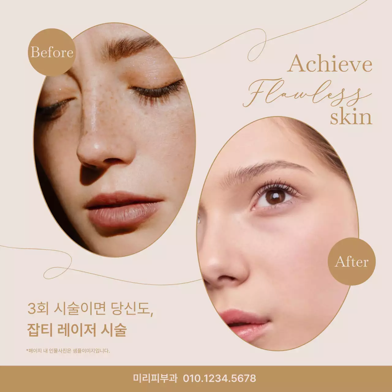 베이지색과 갈색의 미니멀한 피부 레이저 시술 홍보